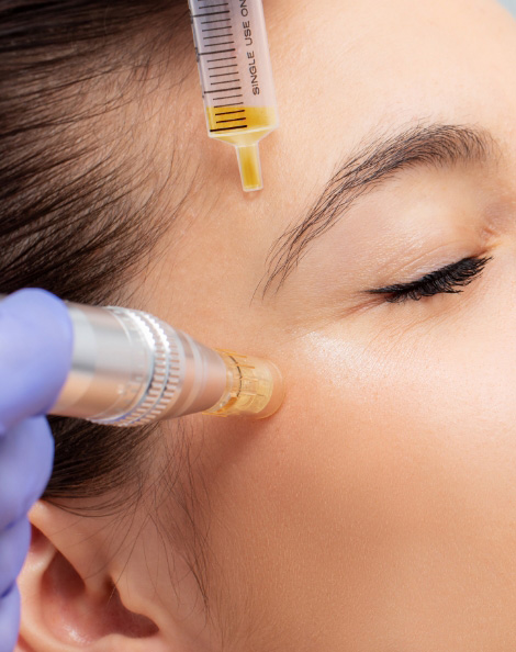 Microneedling 3