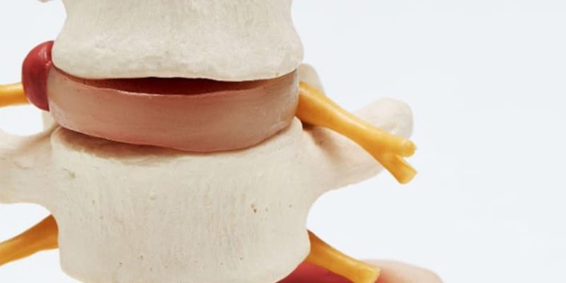 Chiropractors vs. Surgery For Herniated Discs - Our Thoughts post
