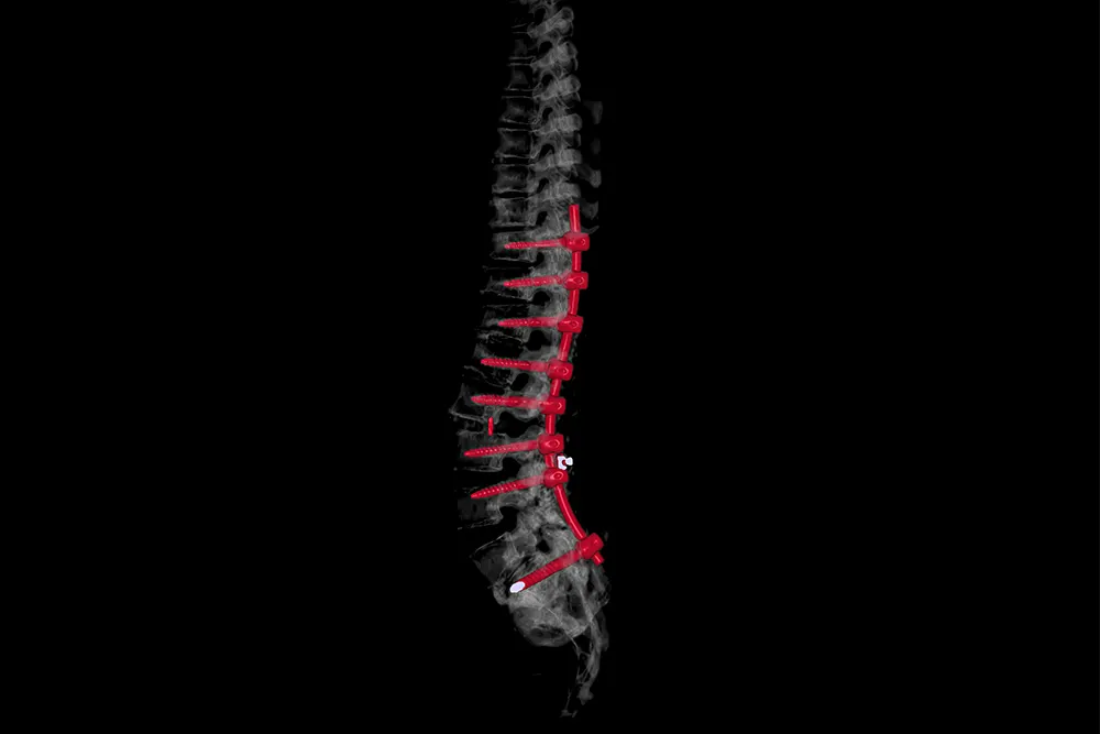 Lumbar Spine